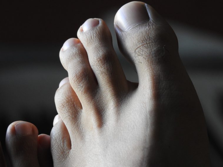 Thick White Stuff Under Toenail? What Is It? Luxe Luminous